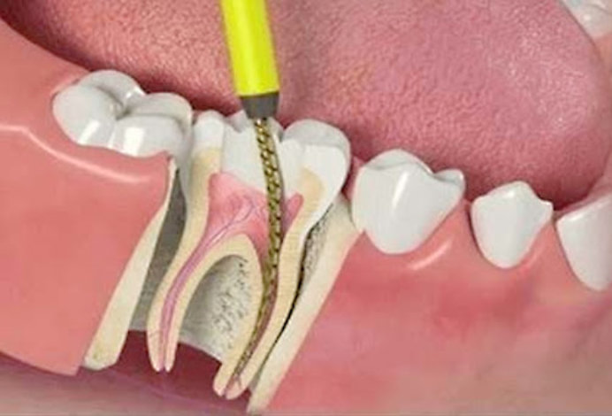 Эндодонтия зубов
