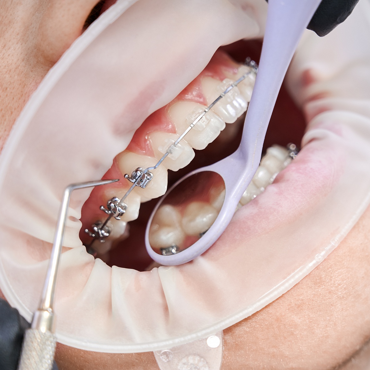 Методы лечения в ортодонтии
